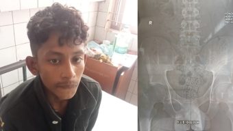 যুবকের পেট থেকে ২২ শ ইয়াবা উদ্ধার